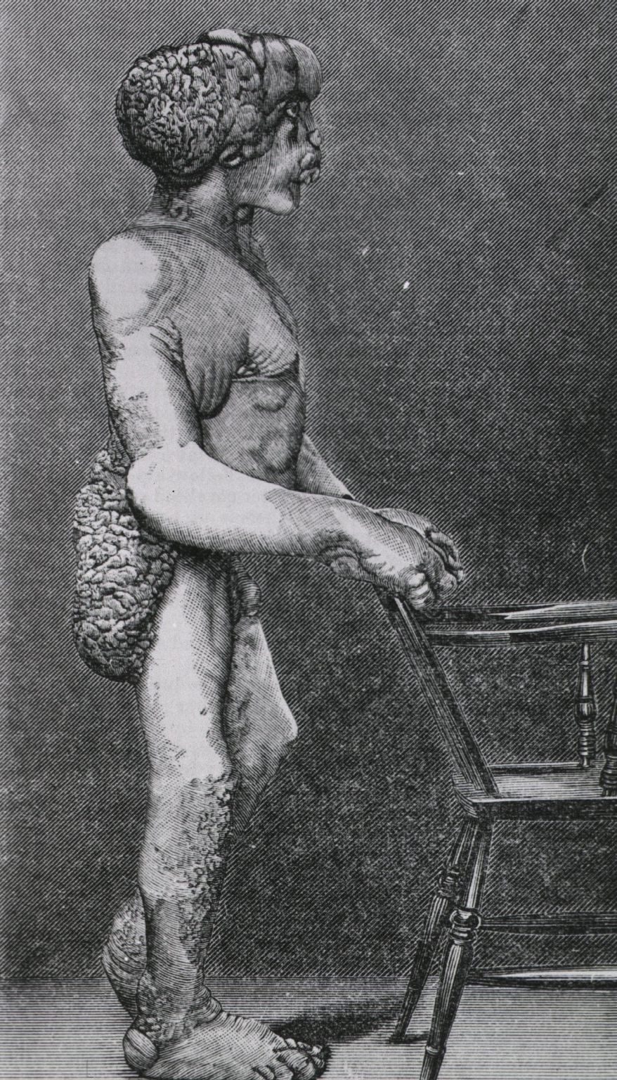 John Merrick British medical journal, v. 2, London, 1886.